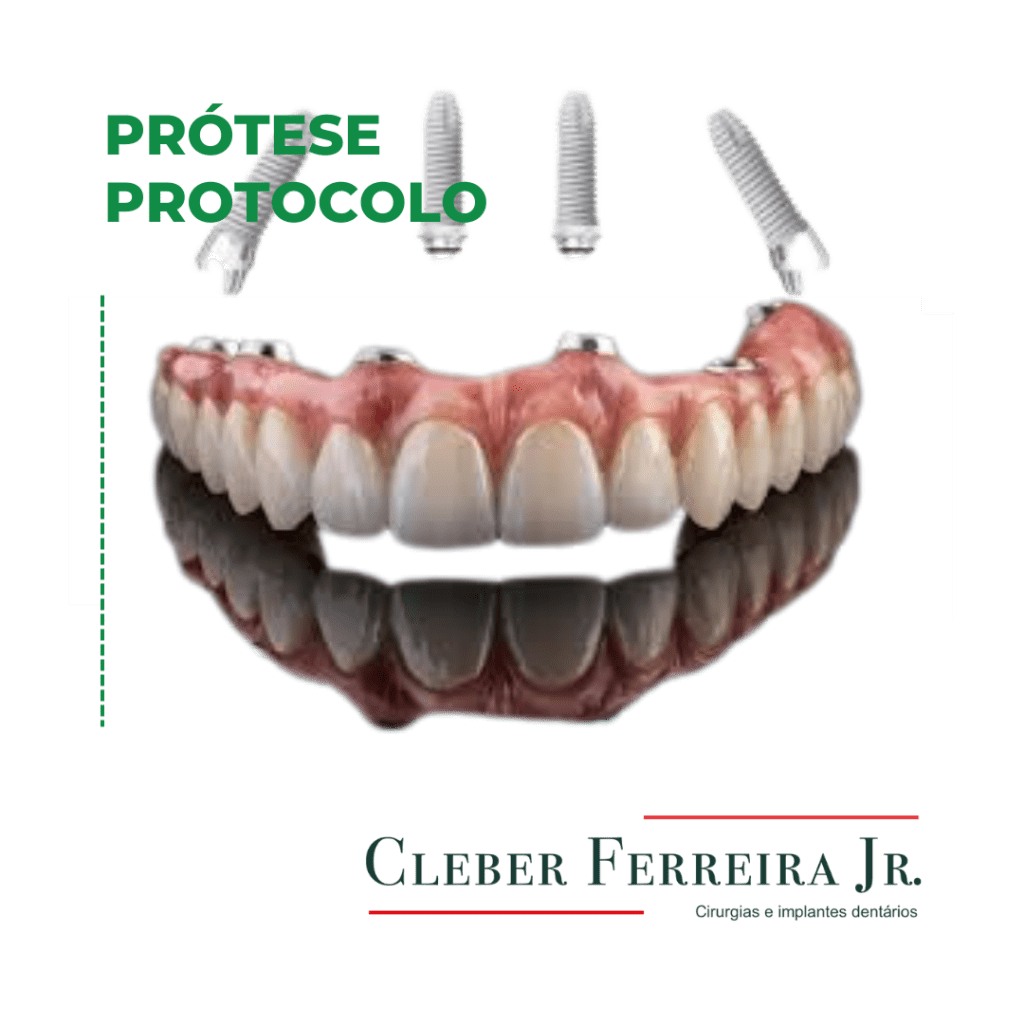 Prótese tipo protocolo