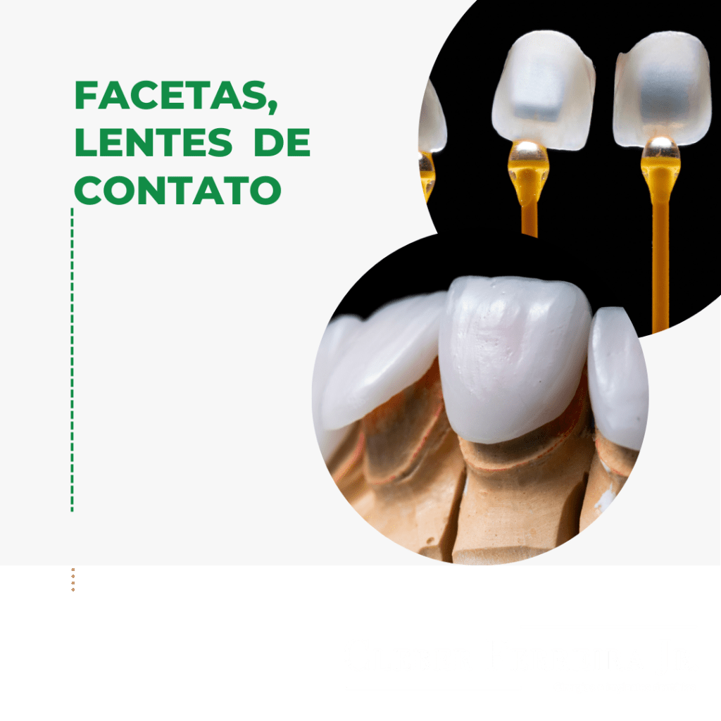 Facetas e lentes de contato em odontologia: transformando&nbsp;sorrisos